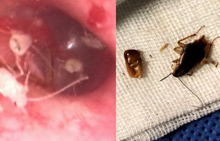 Family of Cockroaches Found Living Inside Man’s Ear