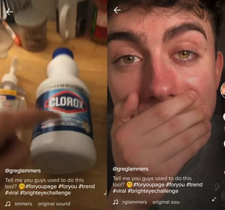 Teenagers are Placing Bags of Bleach on Their Face to “Change” Their