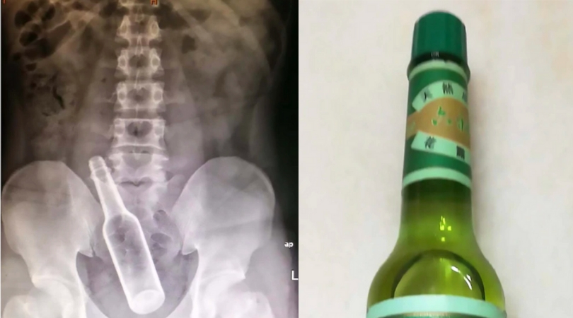 Man Has Seven Inch Glass Bottle Removed From Rectum After Using It To 