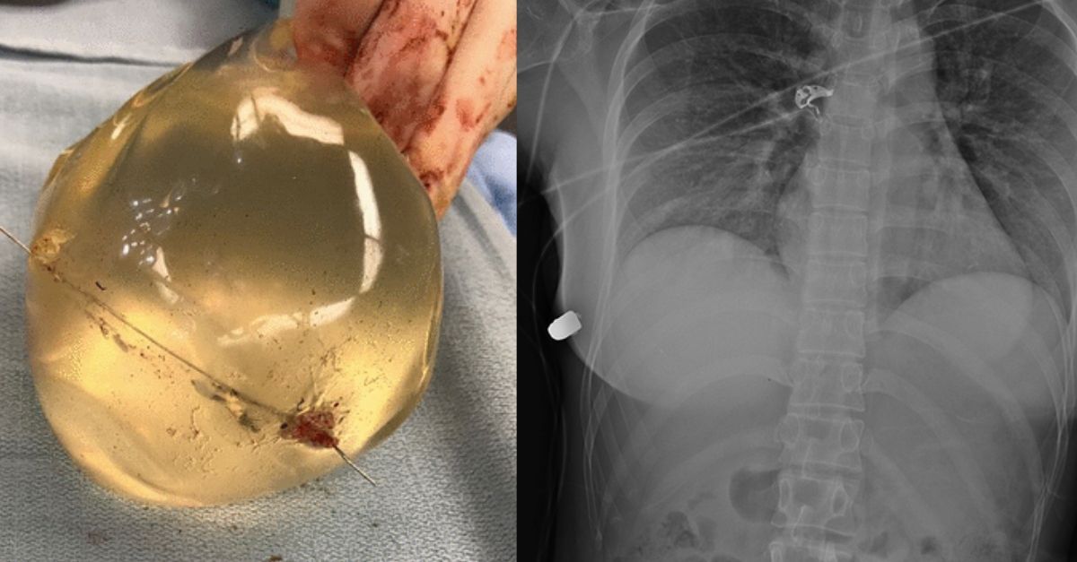 Woman’s Breast Implant Deflects Bullet, Saves Her Life