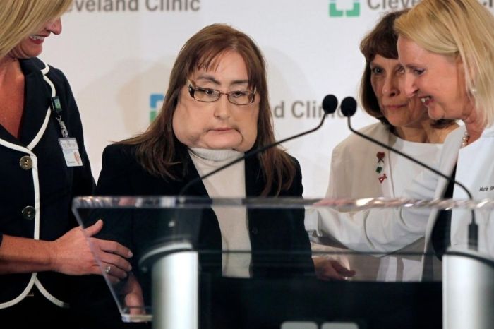 First Face Transplant Recipient in the United States Dies at 57-Years-Old