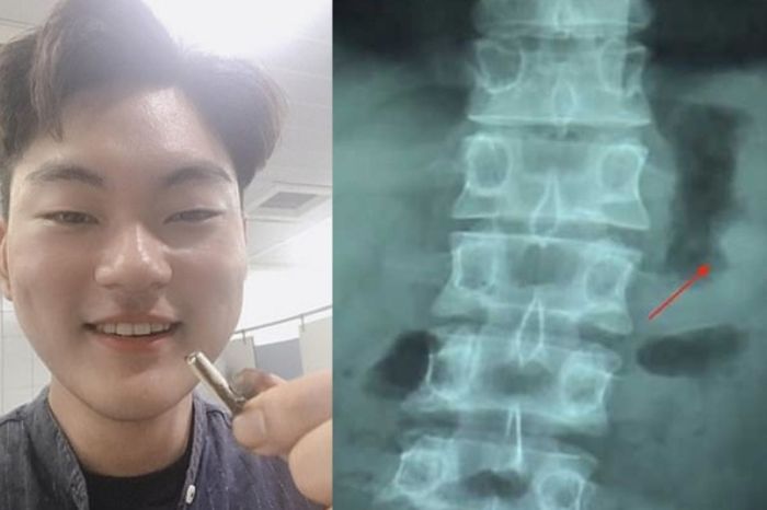 This Guy Accidentally Swallowed His AirPod and it Miraculously Still Worked After Pooping it Out